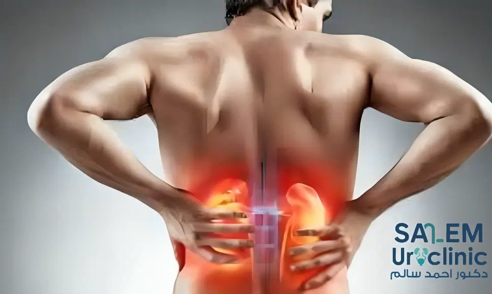 أعراض حصى الكلى